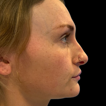 ultrasonic-rhinoplasty-before